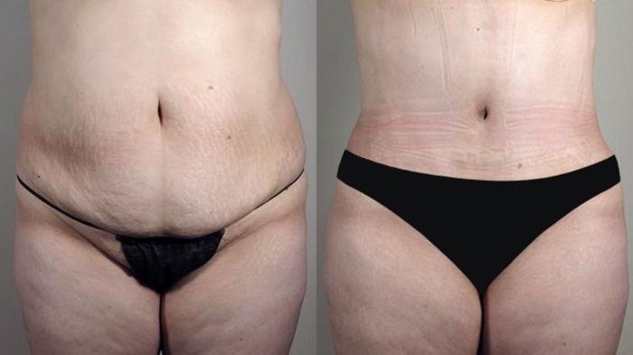 Tummy Tuck Case 741 Before & After View #1 | Paramus, New Jersey | Parker Center for Plastic Surgery