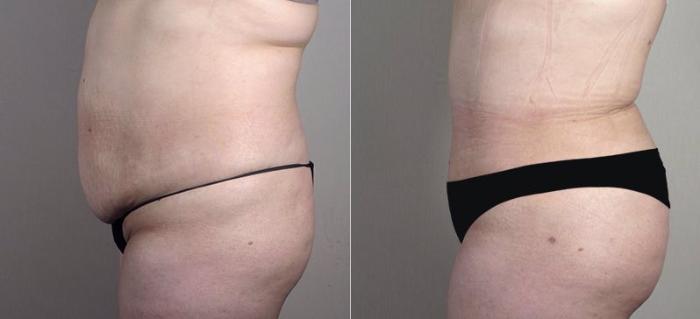 Tummy Tuck Case 741 Before & After View #2 | Paramus, New Jersey | Parker Center for Plastic Surgery