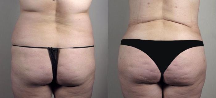 Tummy Tuck Case 741 Before & After View #3 | Paramus, New Jersey | Parker Center for Plastic Surgery