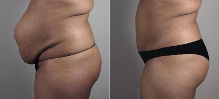 Tummy Tuck Case 742 Before & After View #2 | Paramus, New Jersey | Parker Center for Plastic Surgery