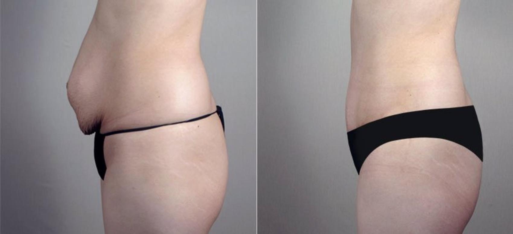 Tummy Tuck Case 744 Before & After View #2 | Paramus, New Jersey | Parker Center for Plastic Surgery