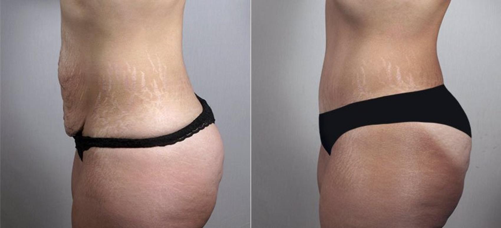 Tummy Tuck Case 745 Before & After View #2 | Paramus, New Jersey | Parker Center for Plastic Surgery