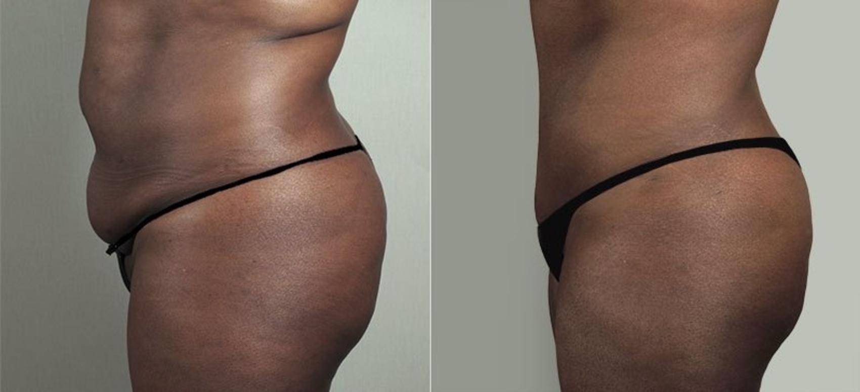 Tummy Tuck Case 747 Before & After View #2 | Paramus, New Jersey | Parker Center for Plastic Surgery
