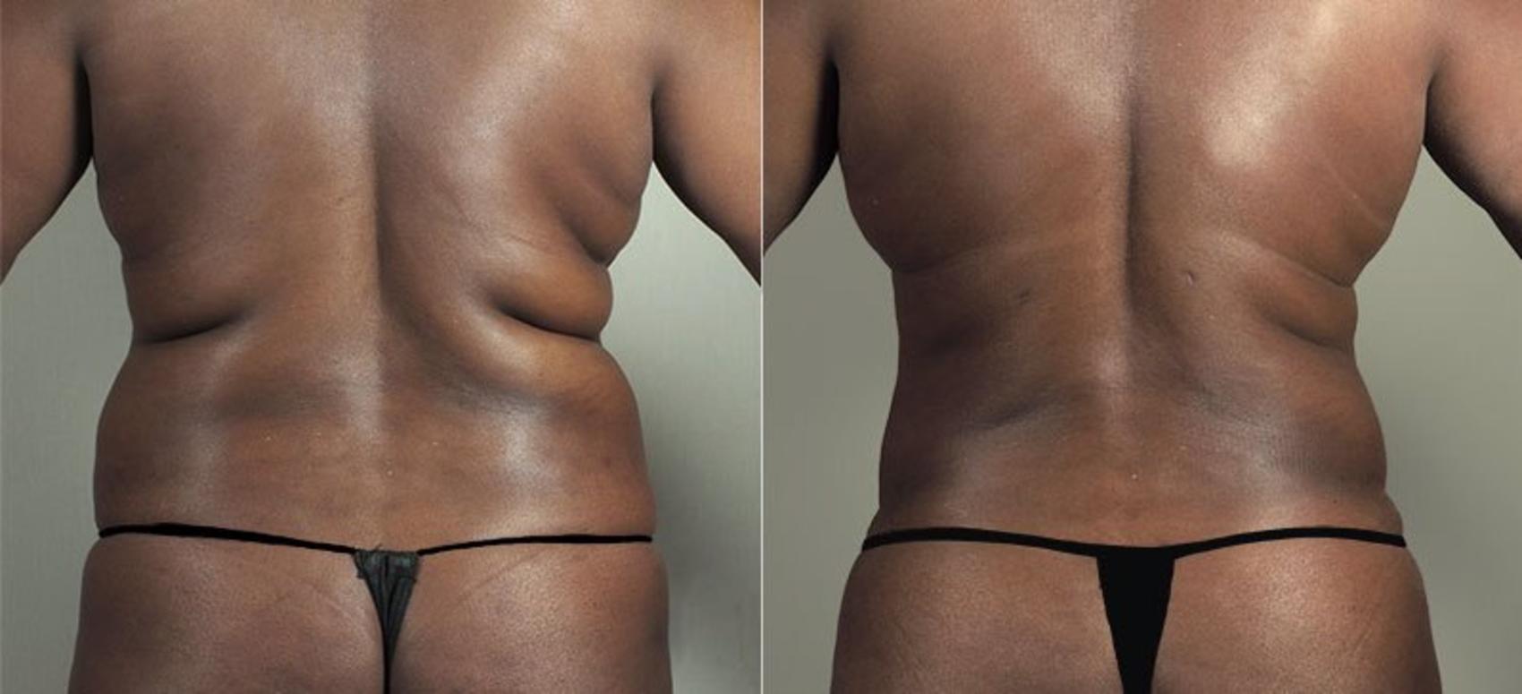 Tummy Tuck Case 747 Before & After View #3 | Paramus, New Jersey | Parker Center for Plastic Surgery