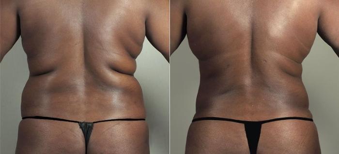 Tummy Tuck Case 747 Before & After View #3 | Paramus, New Jersey | Parker Center for Plastic Surgery