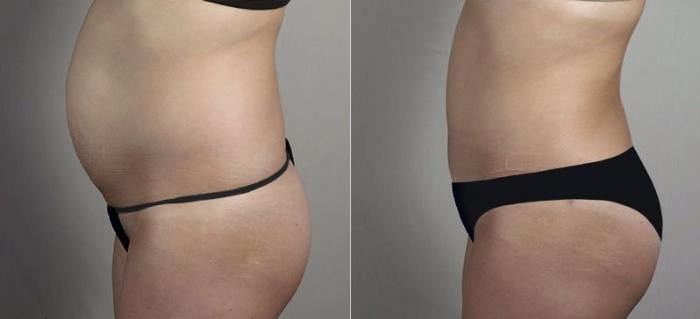 Tummy Tuck Case 748 Before & After View #2 | Paramus, New Jersey | Parker Center for Plastic Surgery