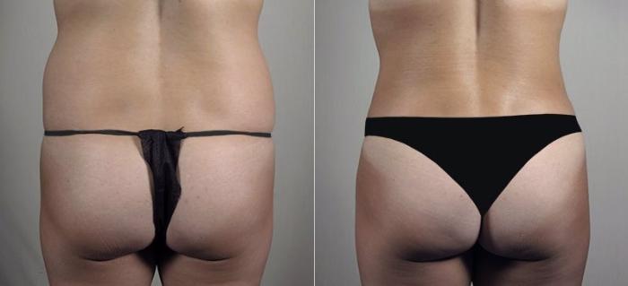 Tummy Tuck Case 748 Before & After View #3 | Paramus, New Jersey | Parker Center for Plastic Surgery