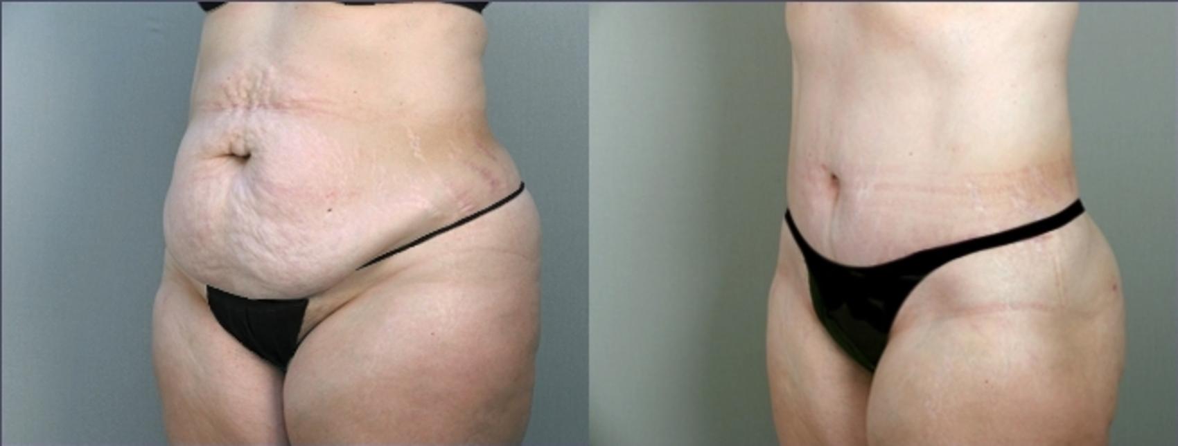 Tummy Tuck Case 912 Before & After View #5 | Paramus, New Jersey | Parker Center for Plastic Surgery