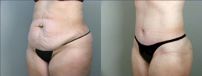 Liposuction Case 912 Before & After View #5 | Paramus, New Jersey | Parker Center for Plastic Surgery