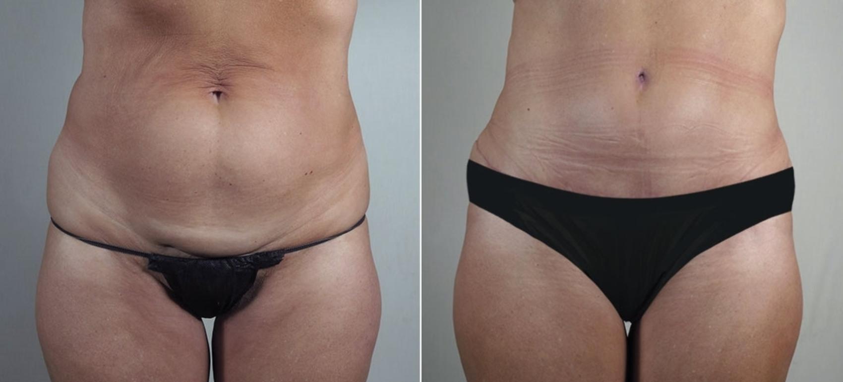 Tummy Tuck Case 913 Before & After View #5 | Paramus, New Jersey | Parker Center for Plastic Surgery