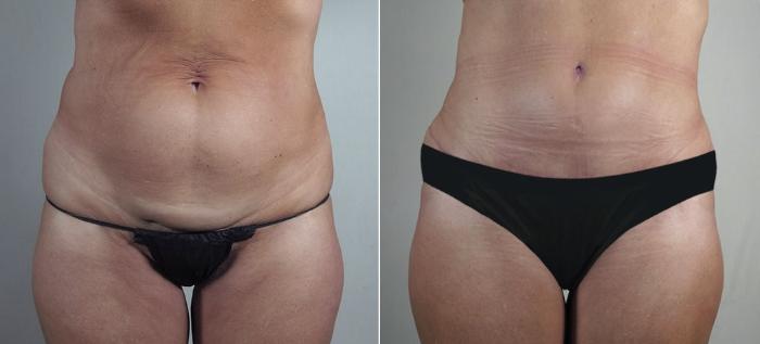 Tummy Tuck Case 913 Before & After View #5 | Paramus, New Jersey | Parker Center for Plastic Surgery