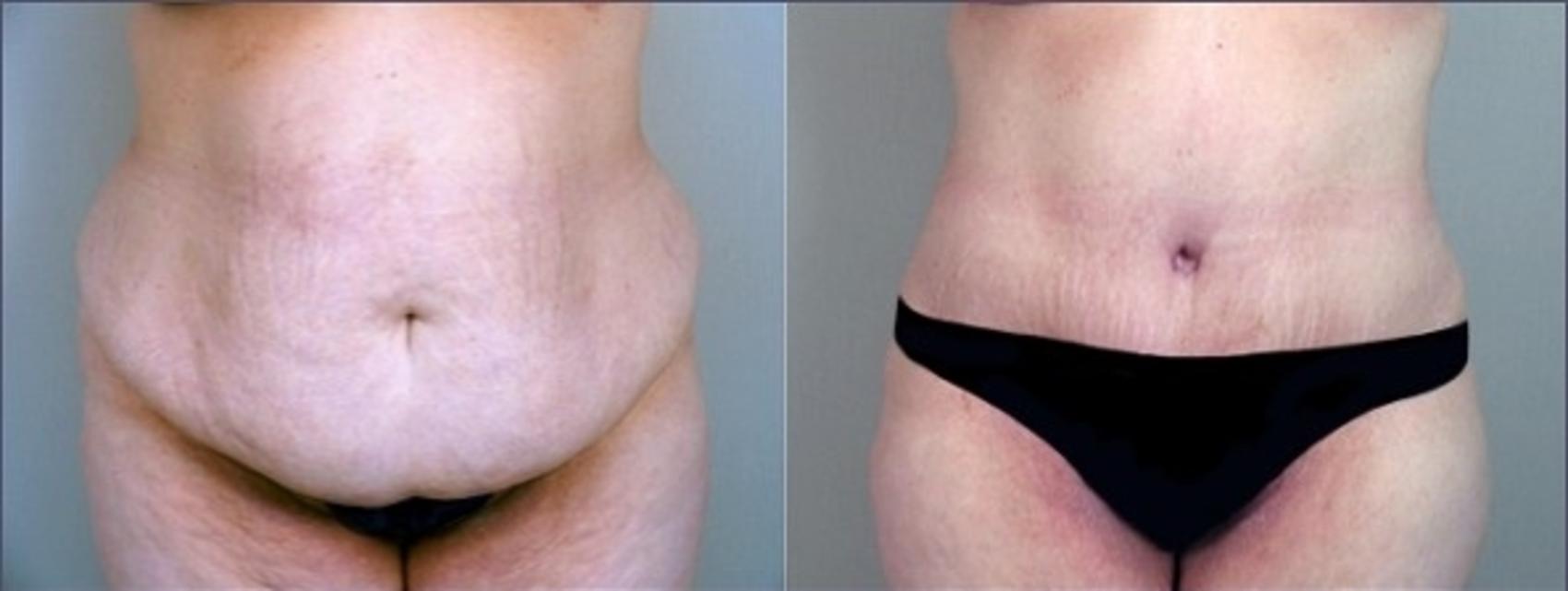 Liposuction Case 919 Before & After View #1 | Paramus, New Jersey | Parker Center for Plastic Surgery