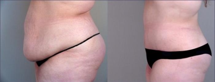 Liposuction Case 919 Before & After View #2 | Paramus, New Jersey | Parker Center for Plastic Surgery