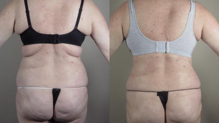 Tummy Tuck Case 987 Before & After Back | Paramus, New Jersey | Parker Center for Plastic Surgery