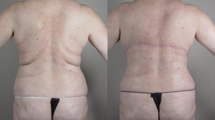 Tummy Tuck Case 987 Before & After Back w/o bra | Paramus, New Jersey | Parker Center for Plastic Surgery
