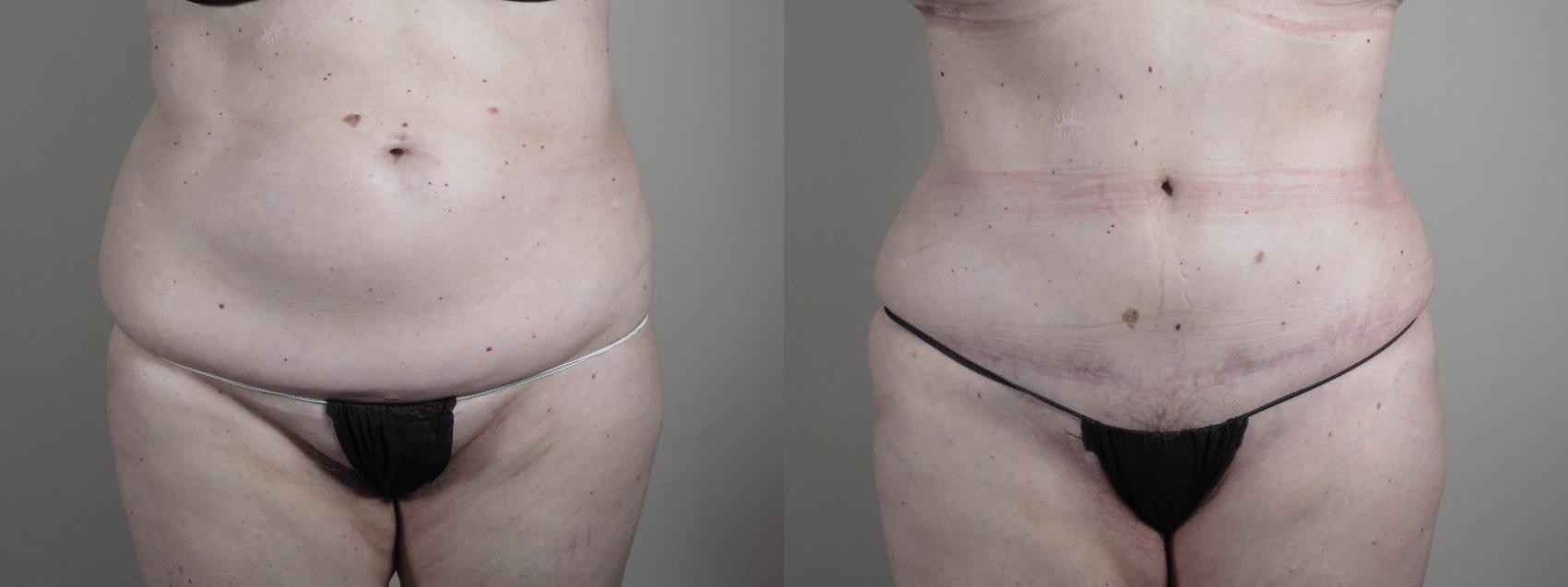 Tummy Tuck Case 987 Before & After Front | Paramus, New Jersey | Parker Center for Plastic Surgery