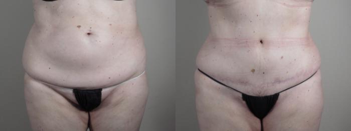 Tummy Tuck Case 987 Before & After Front | Paramus, New Jersey | Parker Center for Plastic Surgery