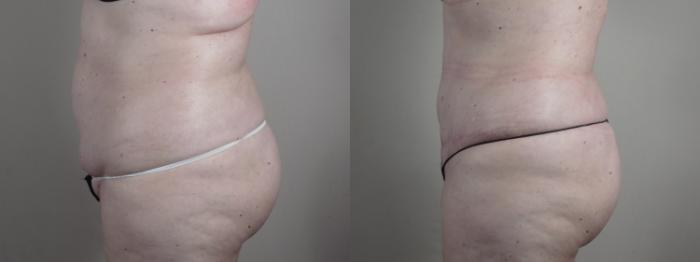 Tummy Tuck Case 987 Before & After Right Side | Paramus, New Jersey | Parker Center for Plastic Surgery