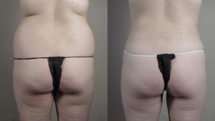 Liposuction Case 990 Before & After Back | Paramus, New Jersey | Parker Center for Plastic Surgery