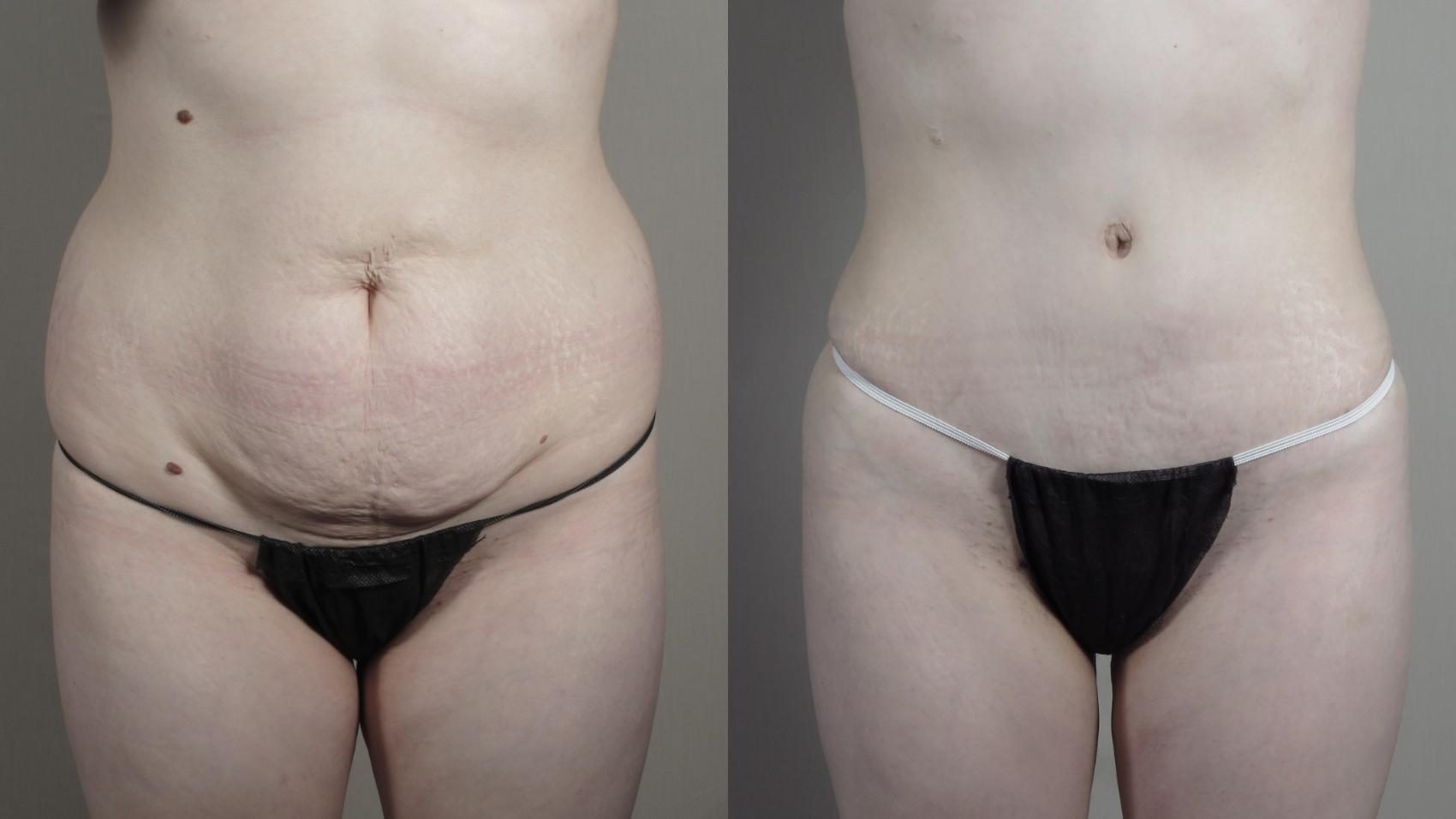Tummy Tuck Case 990 Before & After Front | Paramus, New Jersey | Parker Center for Plastic Surgery
