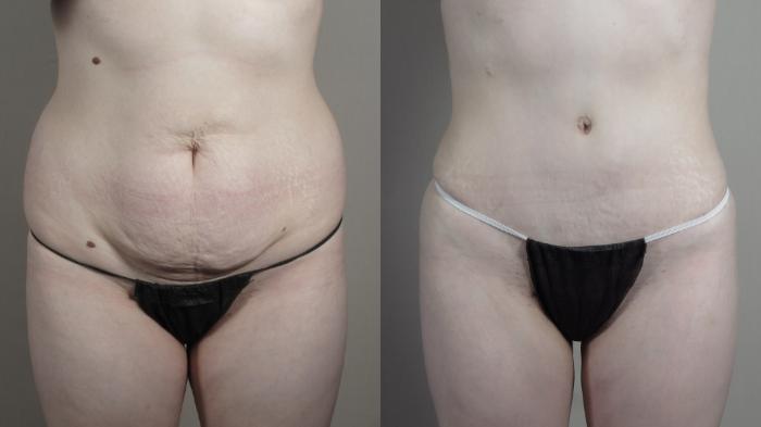 Liposuction Case 990 Before & After Front | Paramus, New Jersey | Parker Center for Plastic Surgery