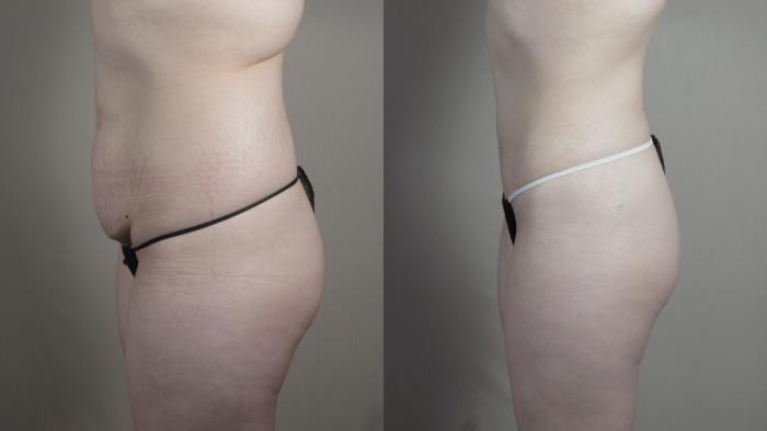 Liposuction Case 990 Before & After Right Side | Paramus, New Jersey | Parker Center for Plastic Surgery