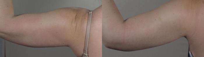 Upper Arm Rejuvenation Case 1095 Before & After Back | Paramus, New Jersey | Parker Center for Plastic Surgery