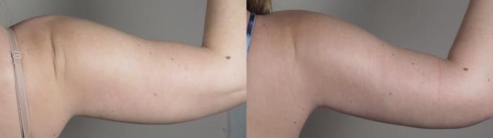 Upper Arm Rejuvenation Case 1095 Before & After back2 | Paramus, New Jersey | Parker Center for Plastic Surgery