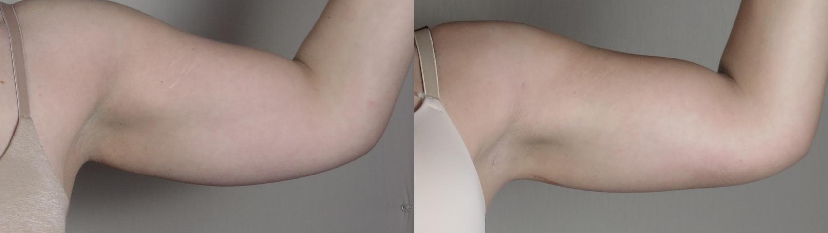 Upper Arm Rejuvenation Case 1095 Before & After Right Side | Paramus, New Jersey | Parker Center for Plastic Surgery