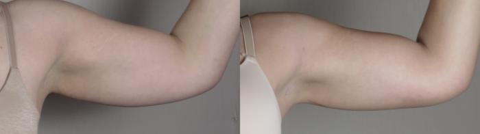 Upper Arm Rejuvenation Case 1095 Before & After Right Side | Paramus, New Jersey | Parker Center for Plastic Surgery