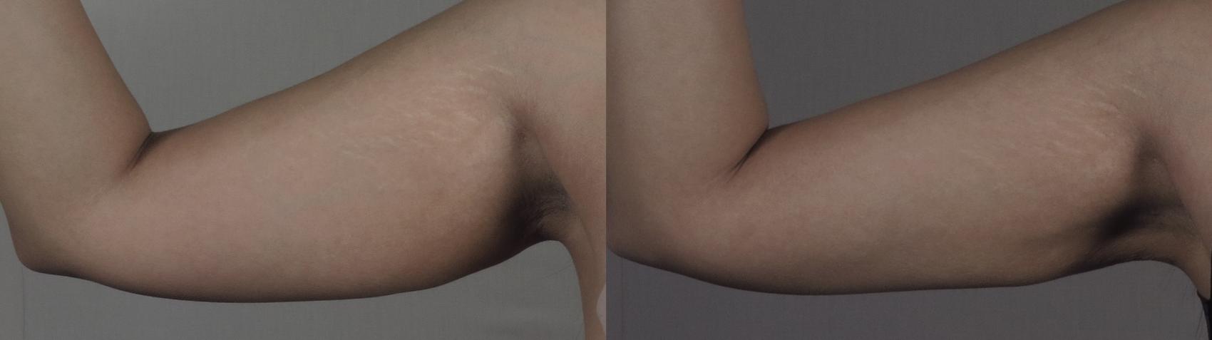 Upper Arm Rejuvenation Case 1198 Before & After View #1  | Paramus, New Jersey | Parker Center for Plastic Surgery