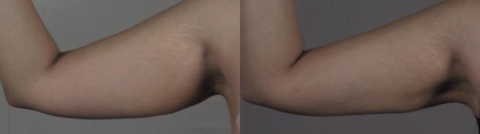 Upper Arm Rejuvenation Case 1198 Before & After View #1  | Paramus, New Jersey | Parker Center for Plastic Surgery
