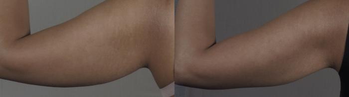 Upper Arm Rejuvenation Case 1198 Before & After View #2 | Paramus, New Jersey | Parker Center for Plastic Surgery