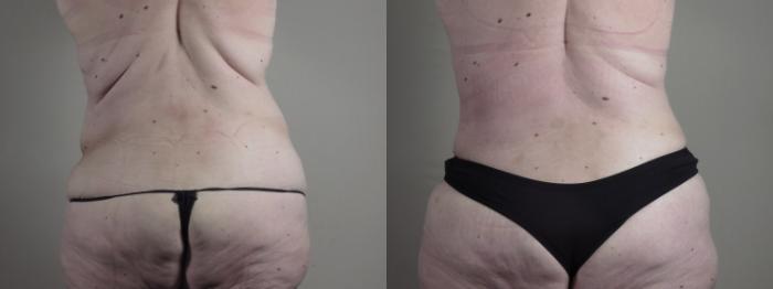 Upper Arm Rejuvenation Case 1286 Before & After back  | Paramus, New Jersey | Parker Center for Plastic Surgery
