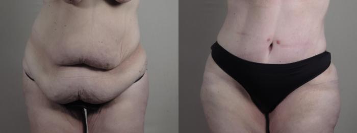 Upper Arm Rejuvenation Case 1286 Before & After front  | Paramus, New Jersey | Parker Center for Plastic Surgery