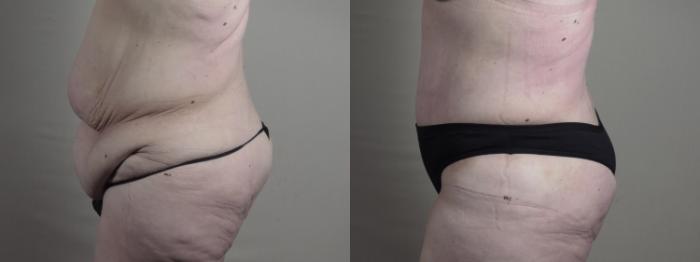 Upper Arm Rejuvenation Case 1286 Before & After Left Side | Paramus, New Jersey | Parker Center for Plastic Surgery