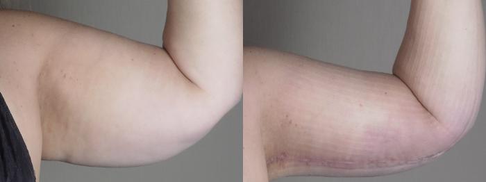 Upper Arm Rejuvenation Case 1287 Before & After arms 2 | Paramus, New Jersey | Parker Center for Plastic Surgery