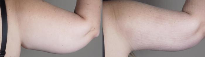 Upper Arm Rejuvenation Case 1287 Before & After back arms 2 | Paramus, New Jersey | Parker Center for Plastic Surgery