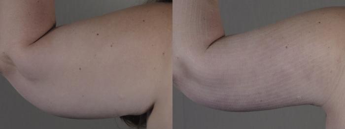 Upper Arm Rejuvenation Case 1287 Before & After Back | Paramus, New Jersey | Parker Center for Plastic Surgery