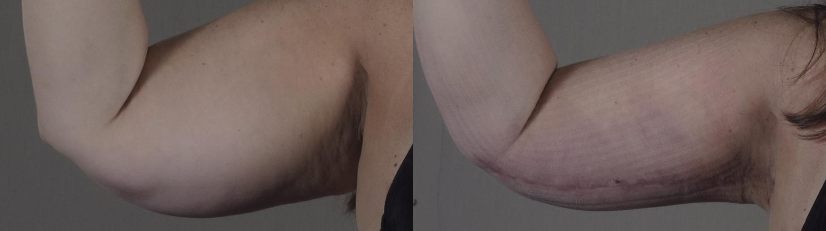 Upper Arm Rejuvenation Case 1287 Before & After Front | Paramus, New Jersey | Parker Center for Plastic Surgery