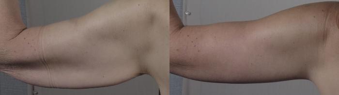 Upper Arm Rejuvenation Case 1303 Before & After Back | Paramus, New Jersey | Parker Center for Plastic Surgery