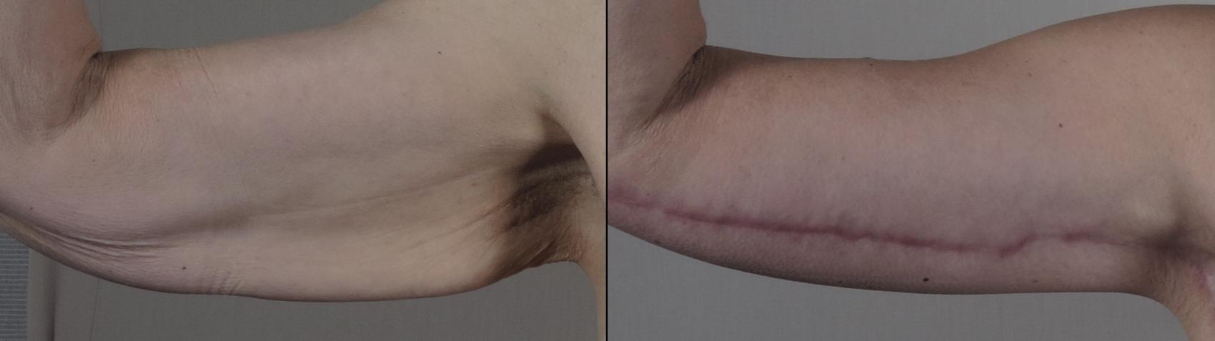 Upper Arm Rejuvenation Case 1303 Before & After Front | Paramus, New Jersey | Parker Center for Plastic Surgery