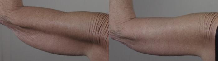 Upper Arm Rejuvenation Case 1308 Before & After Back | Paramus, New Jersey | Parker Center for Plastic Surgery