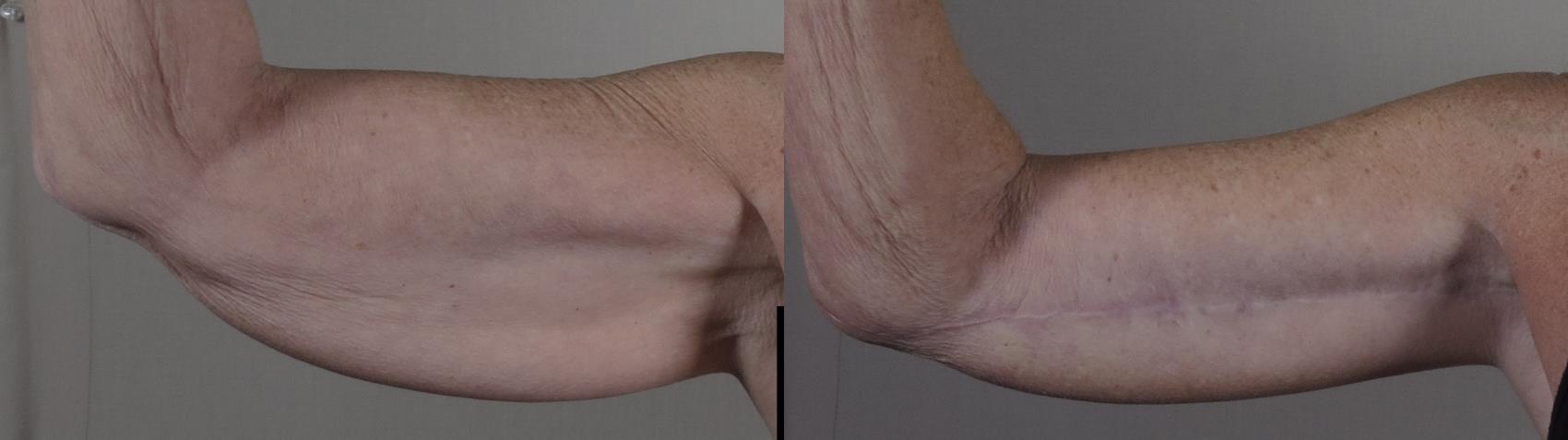 Upper Arm Rejuvenation Case 1308 Before & After Front | Paramus, New Jersey | Parker Center for Plastic Surgery