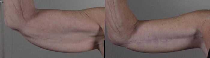 Upper Arm Rejuvenation Case 1308 Before & After Front | Paramus, New Jersey | Parker Center for Plastic Surgery