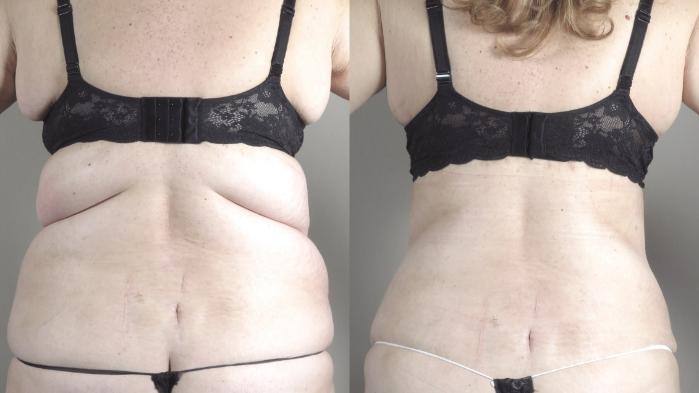 Upper Arm Rejuvenation Case 1316 Before & After back line | Paramus, New Jersey | Parker Center for Plastic Surgery