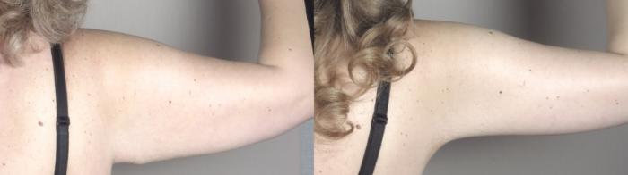 Upper Arm Rejuvenation Case 1316 Before & After Back | Paramus, New Jersey | Parker Center for Plastic Surgery