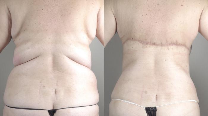 Upper Arm Rejuvenation Case 1316 Before & After bra line 2 | Paramus, New Jersey | Parker Center for Plastic Surgery