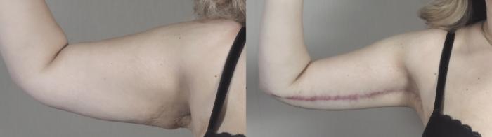 Upper Arm Rejuvenation Case 1316 Before & After Front | Paramus, New Jersey | Parker Center for Plastic Surgery