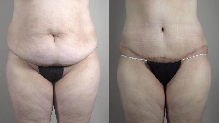 Upper Arm Rejuvenation Case 1316 Before & After front tt | Paramus, New Jersey | Parker Center for Plastic Surgery